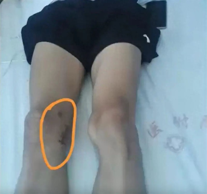 » 7. 百色市医院重大事故 左腿肿瘤切右腿据新京报报道，该17岁男孩于今年3月到百色市右江民族医学院附属医院治疗膝盖，后确诊为左股骨内侧踝骨软骨瘤，左膝关节少量积液