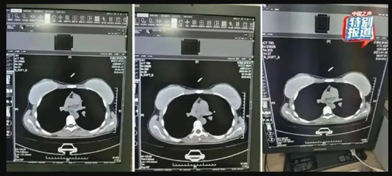 » 2. 无锡医保局确认 本院医生举报无锡虹桥医院骗保初步查实据无锡市医疗保障局微信公众号消息，9月22日，无锡市医保局发布情况通报，9月21日，媒体报道无锡市民营医疗机构无锡虹桥医院涉嫌骗保